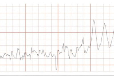 Fig. 4. Filtered electrical impedance signal