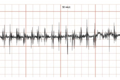 Fig. 2. Initial noisy electrical impedance signal